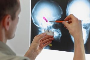 Fractured skull compensation