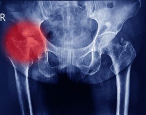 pelvic fracture compensation calculator