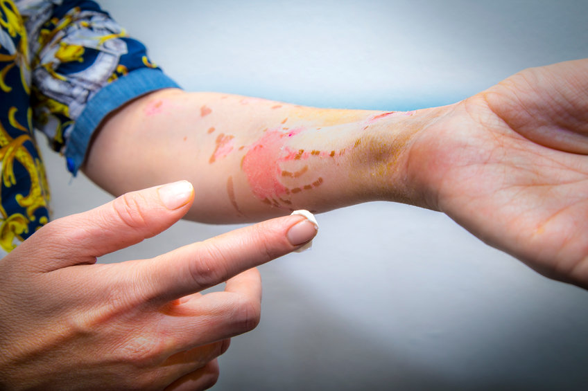 Chemical Burn Claim Burbank thumbnail
