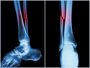 An X-ray image of a broken ankle.