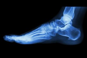 fractured ankle compensation calculator
