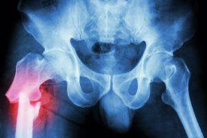hip injury claims