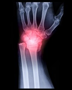 Wrist Fracture Missed 
