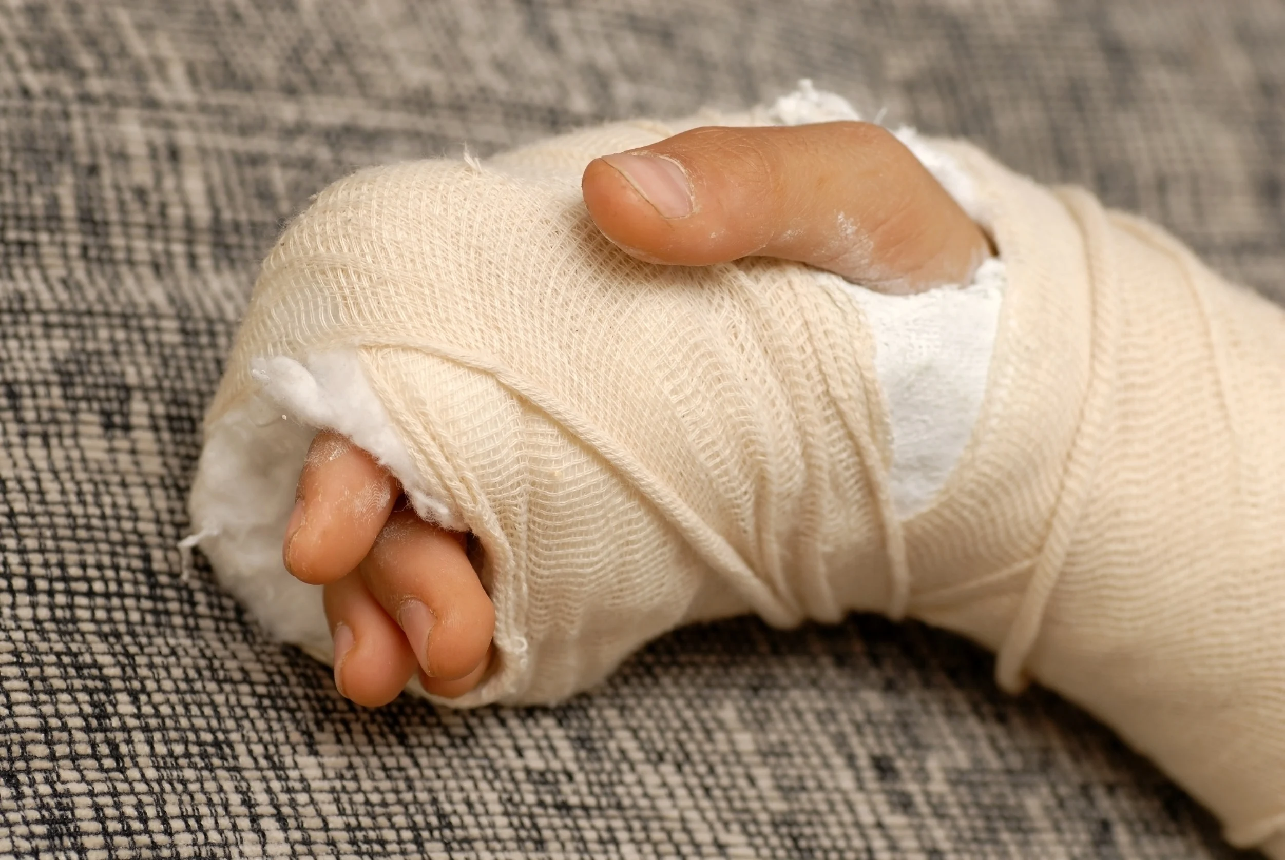 Hand Injury Compensation Calculator - Payouts and Amounts